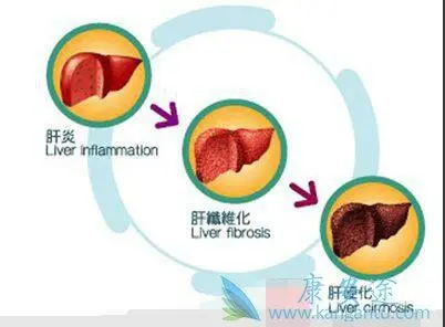 想了解下肝硬化腹水的晚期症状